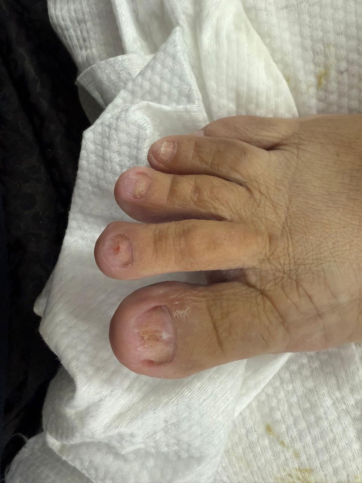 פדיקור רפואי לפני ואחרי